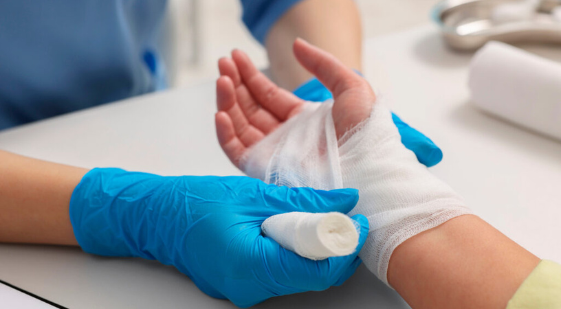 First aid for burns caused by hot-melt adhesive: tips and safety precautions